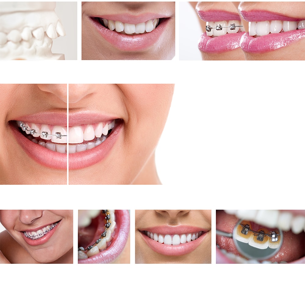 Correction of dental malocclusions with dental braces